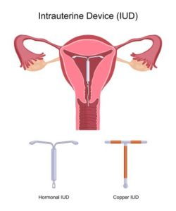Visual representation of Intrauterine devices (IUDs) in female reproductive system